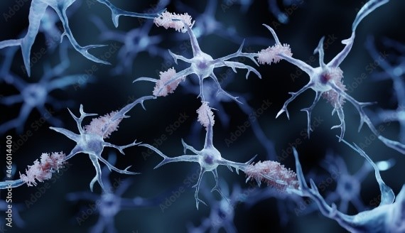 Morbo di Alzheimer: chiarire la formazione di cluster nel cervello